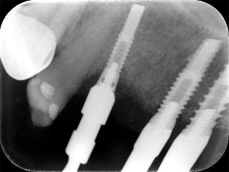 Radiografia degli impianti nell'arcata superiore