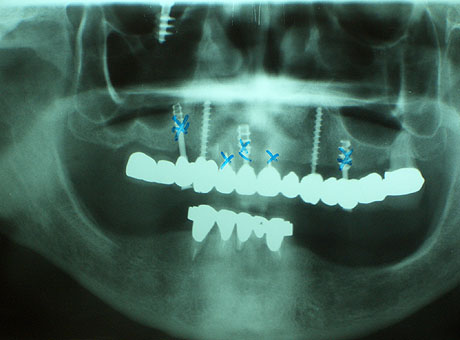 Radiografia panoramica iniziale