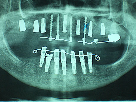 Radiografia panoramica delle arcate con gli impianti inseriti e i provvisori in resina