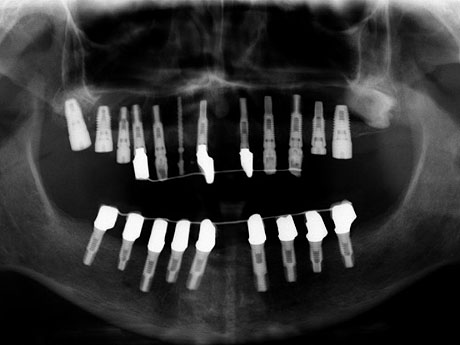 Radiografia panoramica delle arcate con gli impianti inseriti e i provvisori in resina