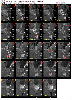 Tac per valutare spessori e altezza dell'osso mascellare residuo