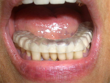 Cura dei sintomi del bruxismo o digrignamento dei denti - Casi clinici