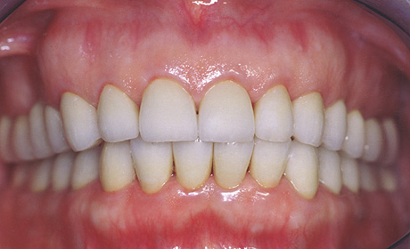 Ricostruzione protesica con corone in zirconia e porcellana