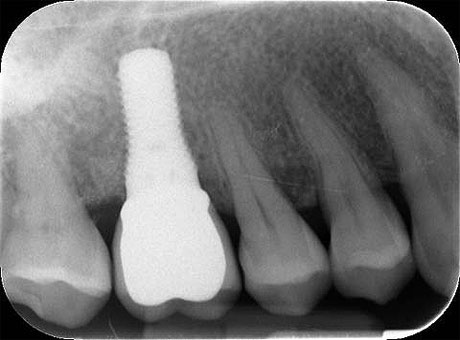 Radiografia di corona e impianto