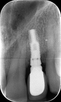 Radiografia dell'impianto e della corona