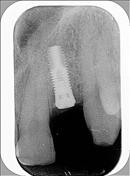 Radiografia dell'impianto