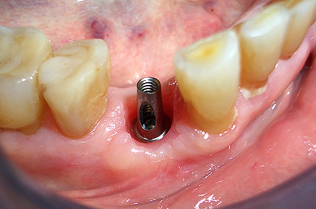 Il moncone in titanio del premolare inferiore destro, il 44, su impianto
