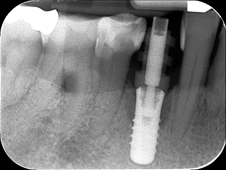 Radiografia dell'impianto 44 all'impronta