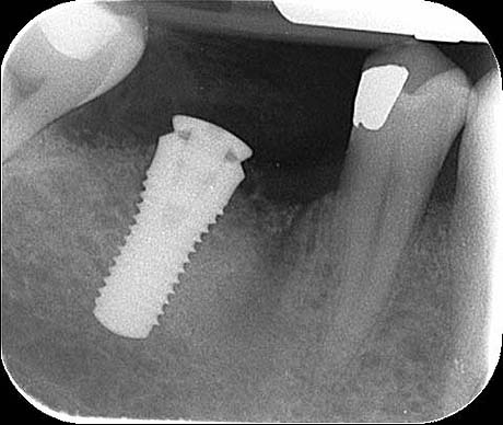 Radiografia dell'impianto