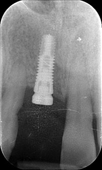 Impianto incisivo destro: radiografia iniziale