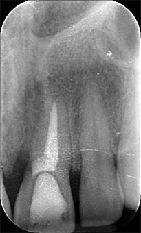 La radiografia del 21 fratturato