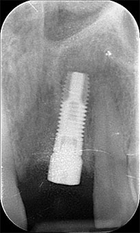 Radiografia impianto inserito con tecnica flapless