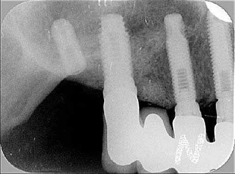 Radiografia della situazione iniziale: l'impianto fratturato.