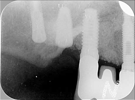 Risultato finale: radiografia dei nuovi impianti