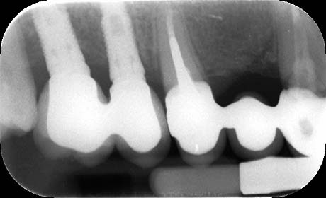 Radiografia impianti 15 e 16 e delle corone in porcellana