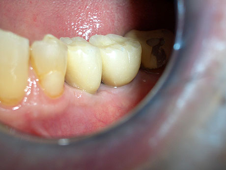 Provvisori 35 e 36. Vecchia corona su dente naturale, 37