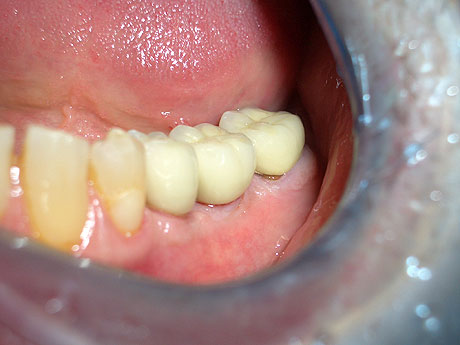 Risultato finale: le due corone in porcellana 35-36 su impianti e 37 su dente naturale