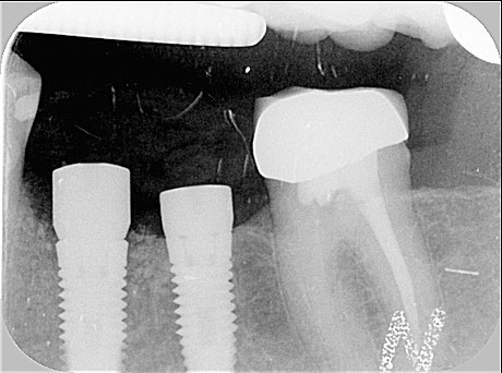 Radiografia impianti 35 e 36