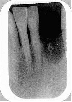 Radiografia della zona degli incisivi estratti