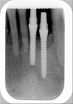 Radiografia degli impianti 31 e 32 inseriti