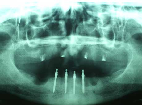 Radiografia panoramica con impianti inferiori inseriti