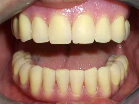 Overdenture con la bocca aperta