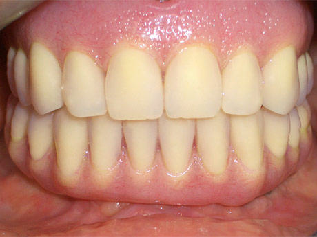 Overdenture con la bocca chiusa