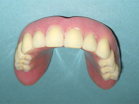 Overdenture superiore