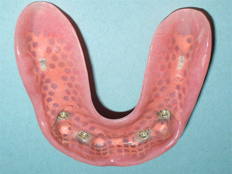 Overdenture: vista interna degli attacchi