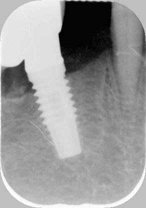 Radiografia dente 42 da estrarre e per l'inserimento dell'impianto nel 43. Visibile l'impianto nel 44, gi esistente.