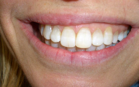 Grazie al trattamento di sbiancamento integrato laser-ultrasuoni, si è ottenuta l'uniformità del colore e della tessitura dello smalto Grazie al trattamento di sbiancamento integrato laser-ultrasuoni, si è ottenuta l'uniformità del colore e della tessitura dello smalto