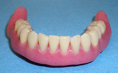 Immagine di una overdenture inferiore con quattro attacchi per impianti dentari